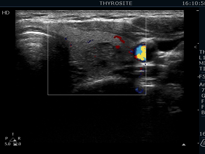 Right lobe, longitudinal scan