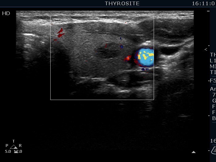 Right lobe, longitudinal scan