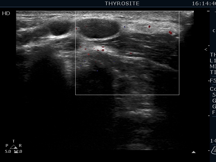 Right lobe, longitudinal scan