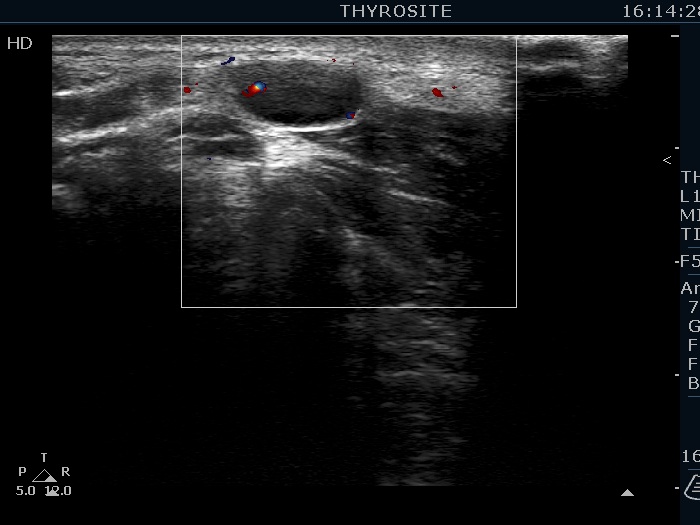 Right lobe, longitudinal scan