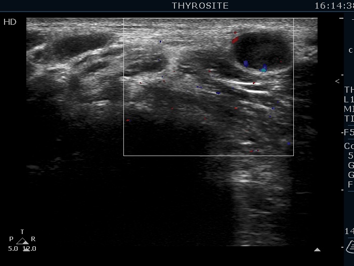 Right lobe, longitudinal scan