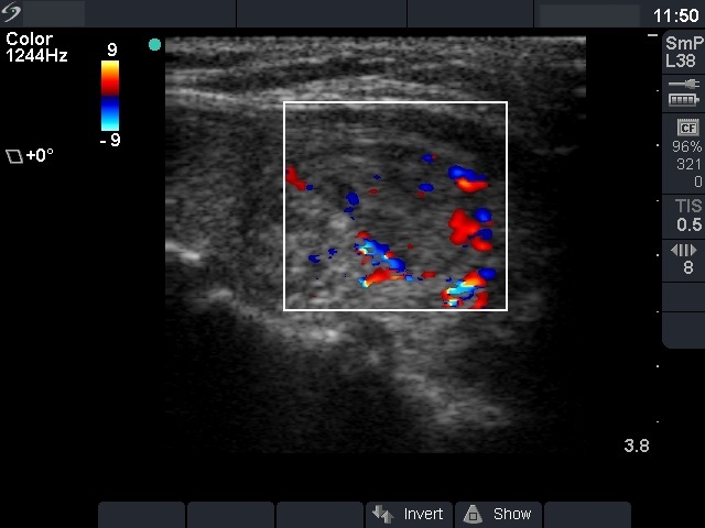 Right lobe, longitudinal scan