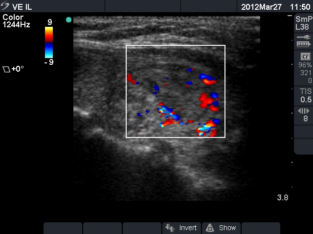 Right lobe, longitudinal scan
