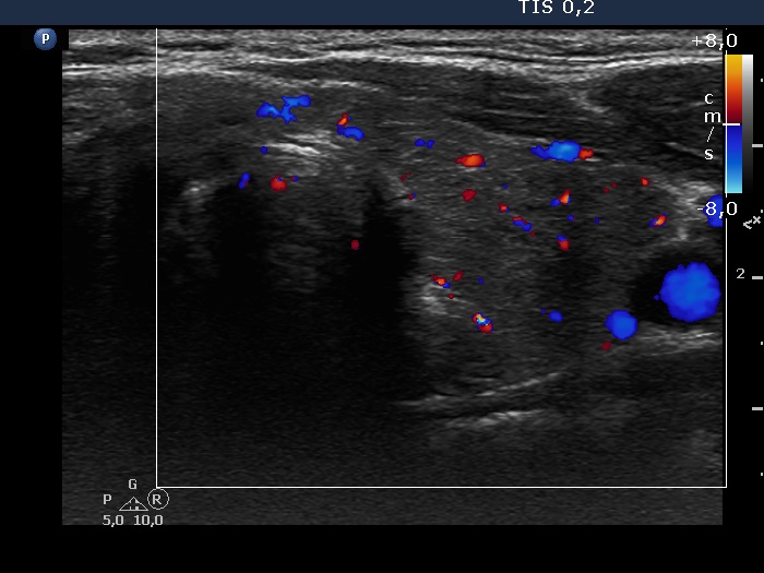 Right lobe, longitudinal scan