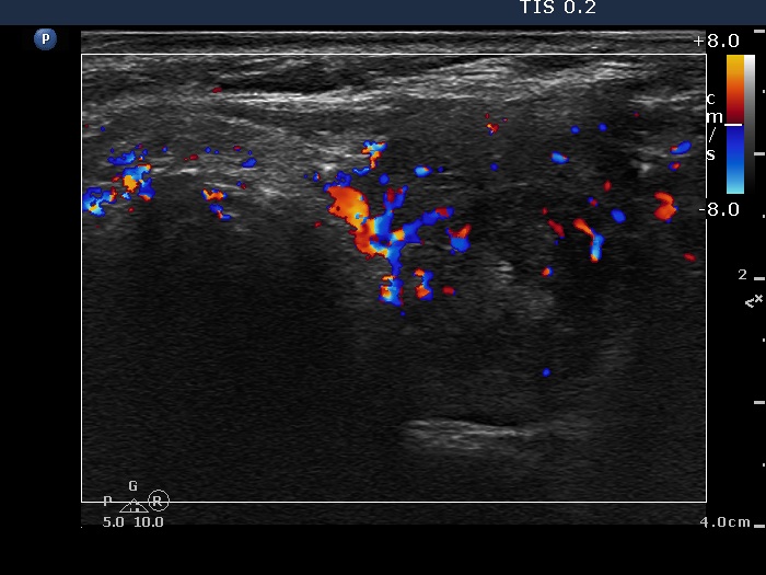 Right lobe, longitudinal scan