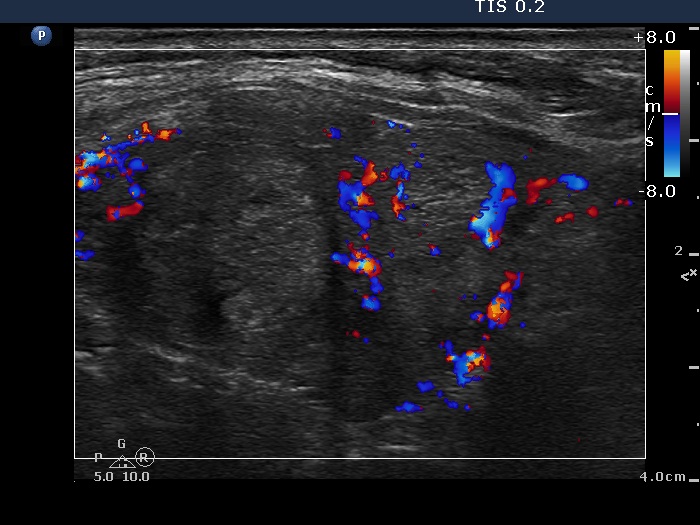 Right lobe, longitudinal scan