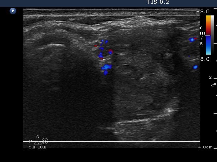 Right lobe, longitudinal scan