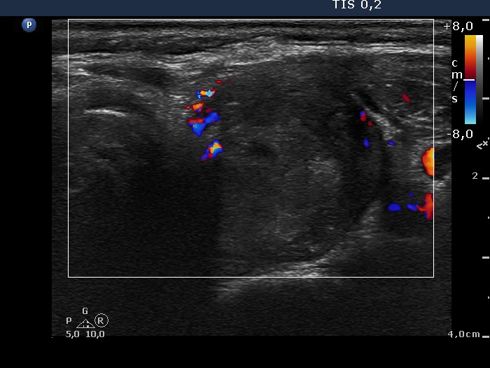 Right lobe, longitudinal scan