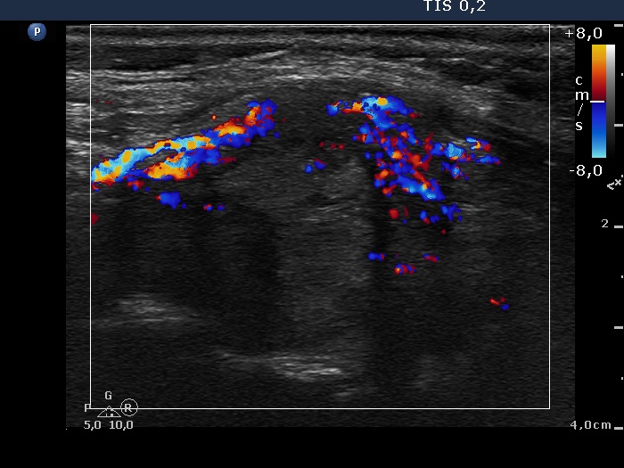 Right lobe, longitudinal scan
