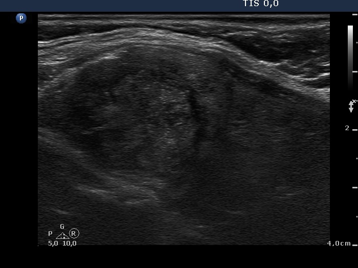 Right lobe, longitudinal scan