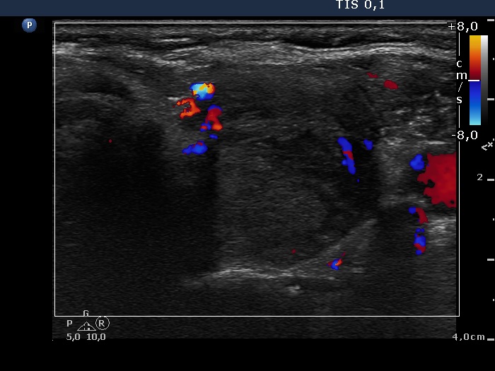 Right lobe, longitudinal scan