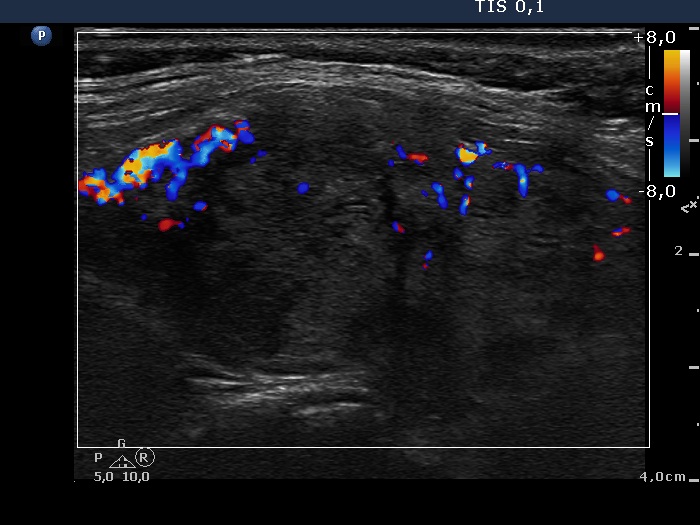Right lobe, longitudinal scan