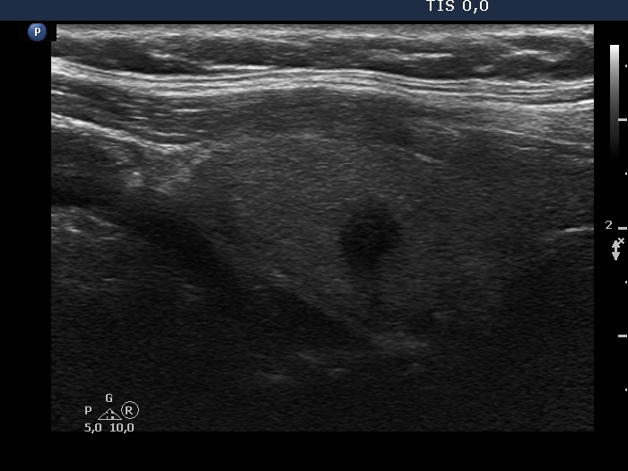 Right lobe, longitudinal scan