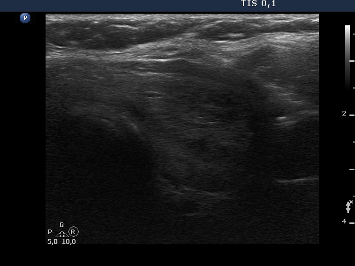 Right lobe, longitudinal scan