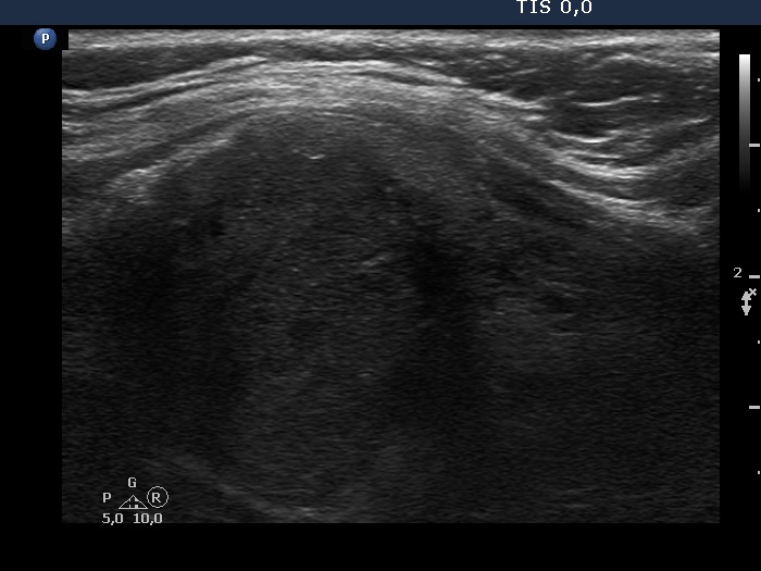 Right lobe, longitudinal scan