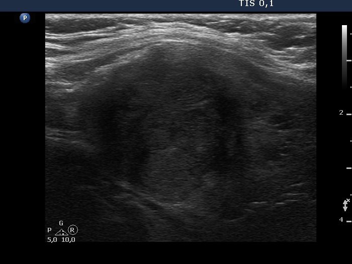 Right lobe, longitudinal scan