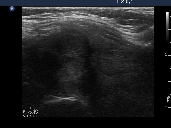Right lobe, longitudinal scan