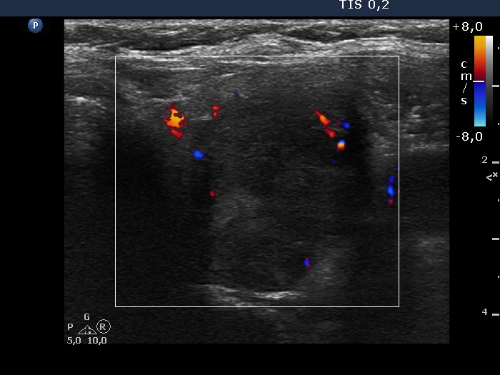 Right lobe, longitudinal scan