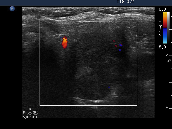 Right lobe, longitudinal scan