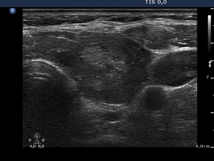 Right lobe, longitudinal scan