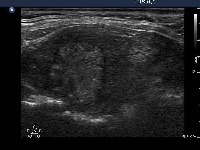Right lobe, longitudinal scan