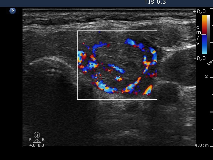 Right lobe, longitudinal scan