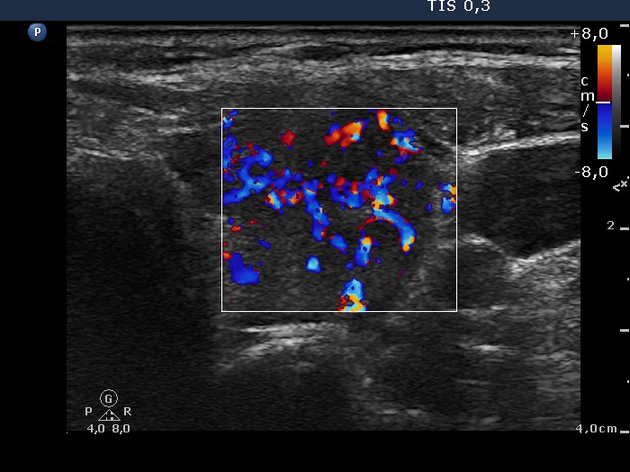 Right lobe, longitudinal scan