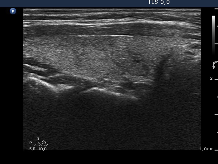 Right lobe, longitudinal scan
