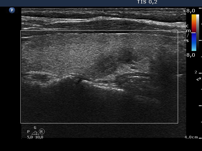 Right lobe, longitudinal scan