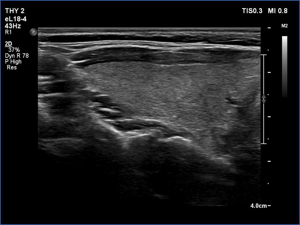 Right lobe, longitudinal scan