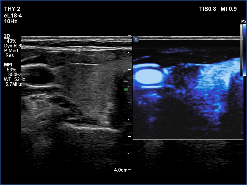 Right lobe, longitudinal scan