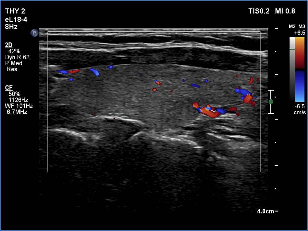 Right lobe, longitudinal scan
