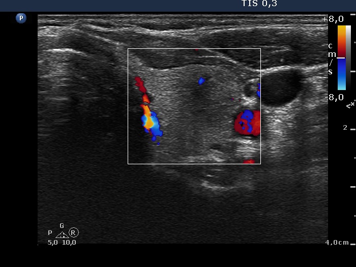 Right lobe, longitudinal scan