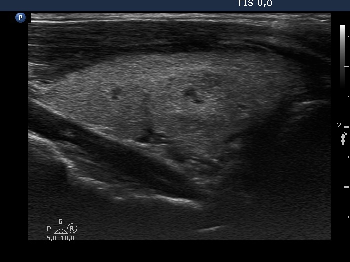 Right lobe, longitudinal scan