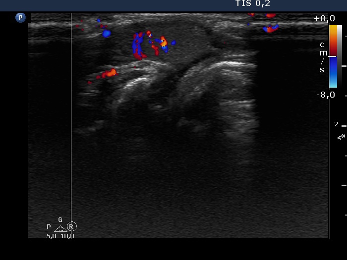 Right lobe, longitudinal scan