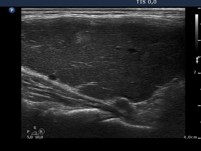 Right lobe, longitudinal scan