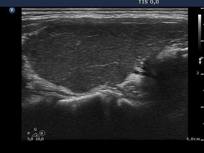 Right lobe, longitudinal scan