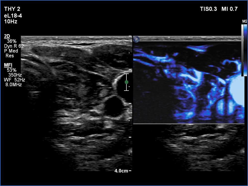 Right lobe, longitudinal scan