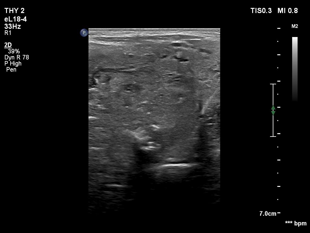 Right lobe, longitudinal scan