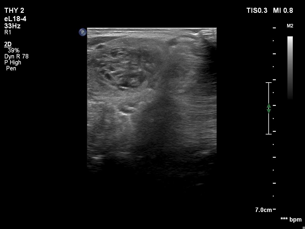 Right lobe, longitudinal scan