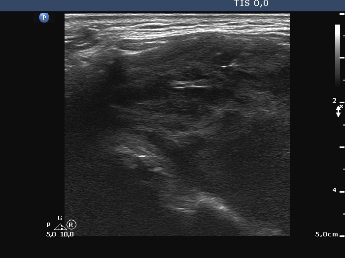 Right lobe, longitudinal scan