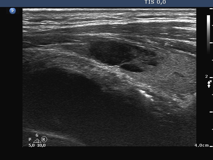 Right lobe, longitudinal scan