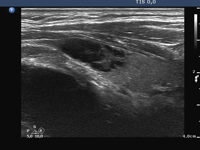 Right lobe, longitudinal scan