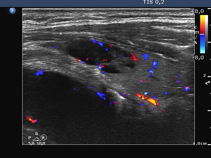 Right lobe, longitudinal scan