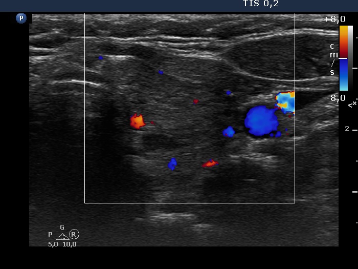 Right lobe, longitudinal scan