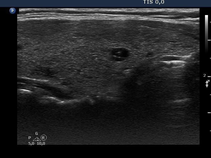 Right lobe, longitudinal scan