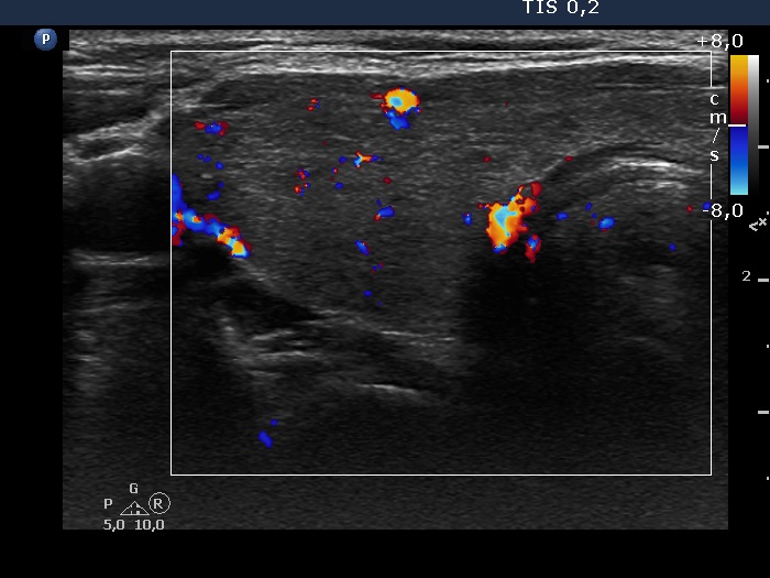 Right lobe, longitudinal scan