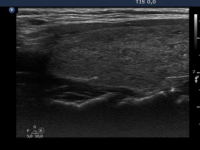 Right lobe, longitudinal scan