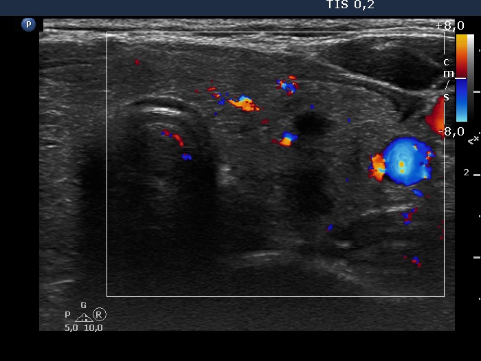 Right lobe, longitudinal scan