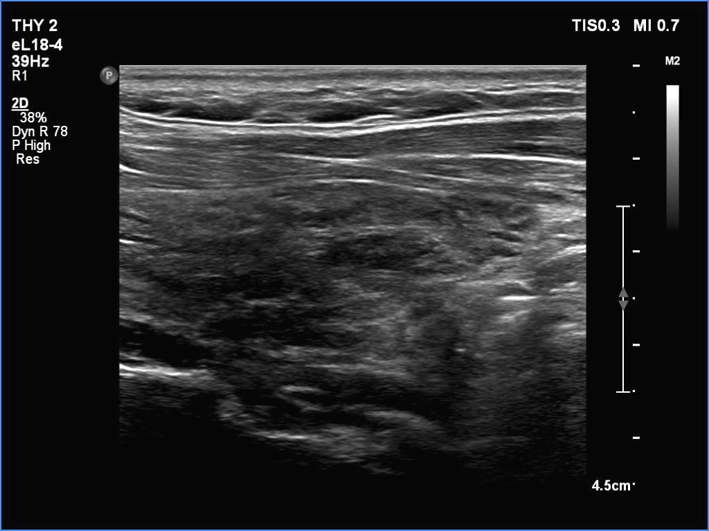Right lobe, longitudinal scan